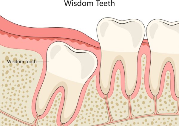 wisdom teeth 2 wisdom teeth 2